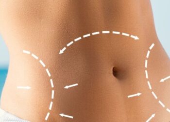 Lipoescultura 360: Transformando el Contorno Corporal