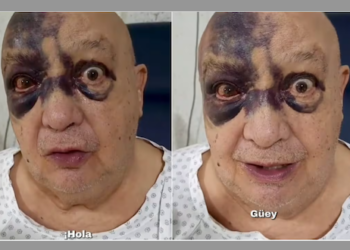 Luis de Alba sufre accidente y aparece con el rostro lleno de moretones